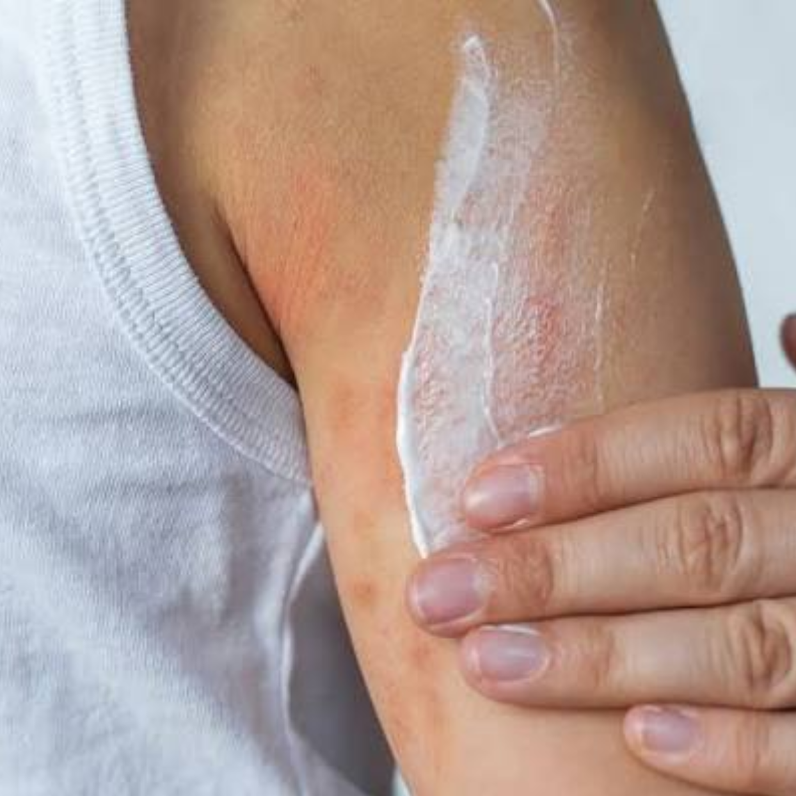 Dry Skin and Eczema