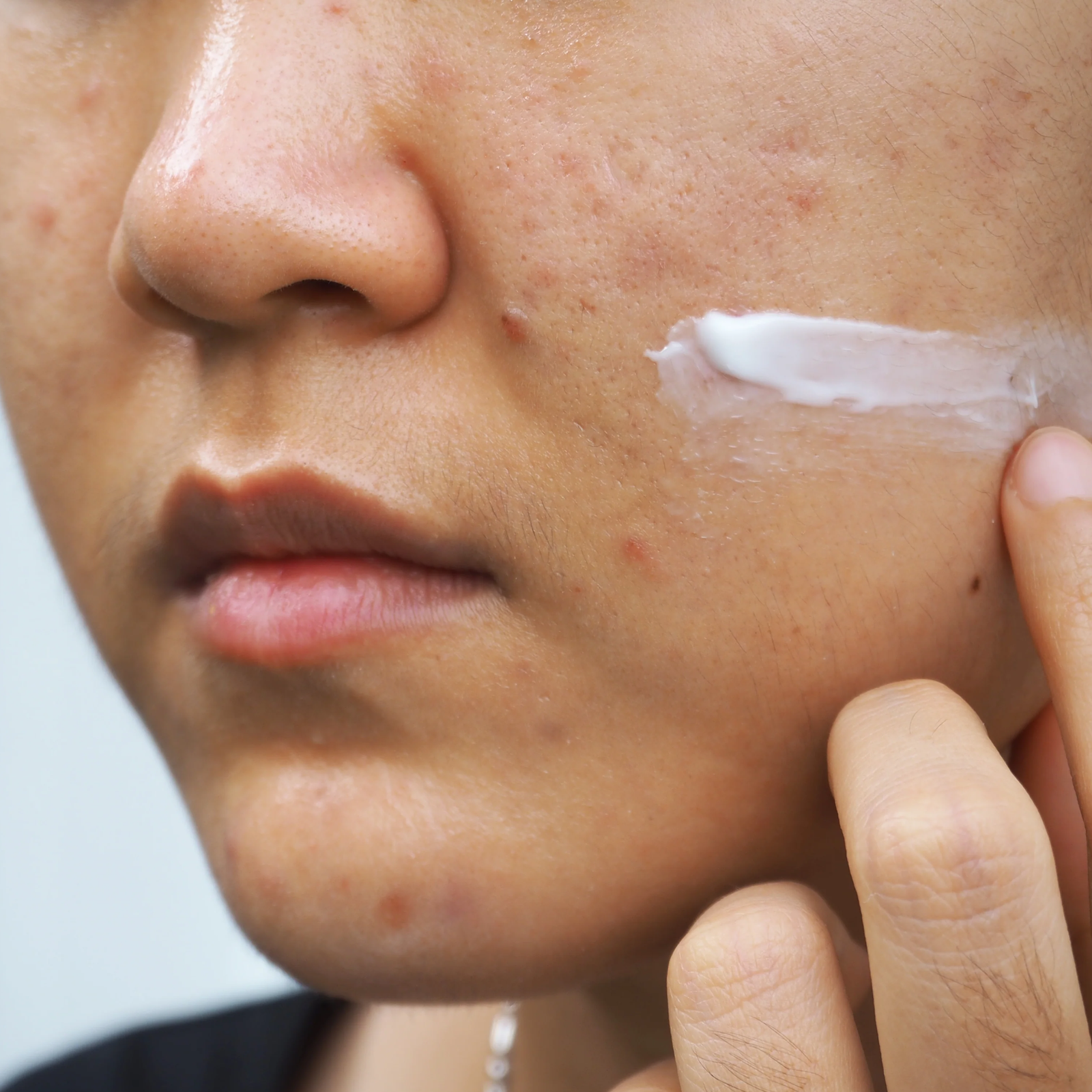 Acne and Blemish-prone Skin